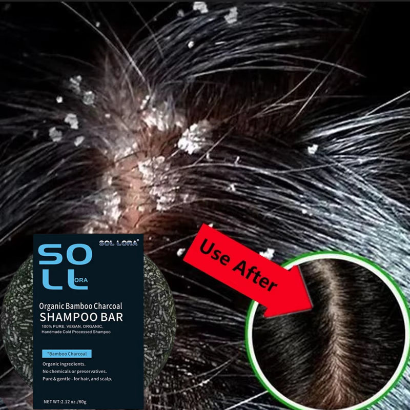 Hair Care Dandruff - 高速抗フケヘアトリートメント石鹸かゆみ修復頭皮クリーニング角質除去製品オイルコントロール鎮痒ヘアケア