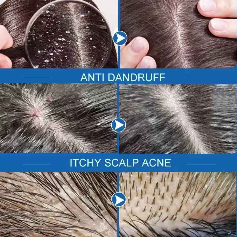 高速抗フケヘアトリートメント石鹸かゆみ修復頭皮クリーニング角 - Hair Care Dandruff のレビューと価格