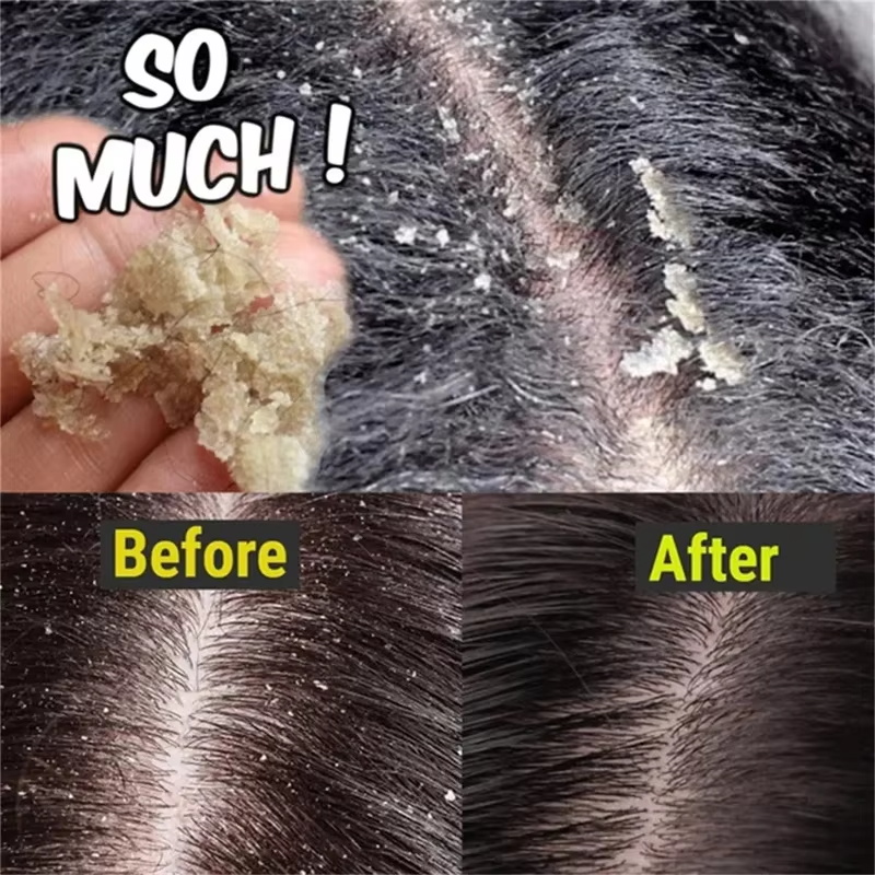 高速抗フケヘアトリートメント石鹸かゆみ修復頭皮クリーニング角 - Hair Care Dandruff のレビューと価格
